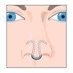 Dilatateur nasal anti-ronflements et Sportifs CLIPAIR Dilatateur nasal anti-ronflements